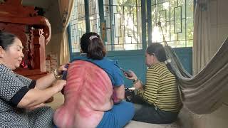 Cạo Gió Cho Cô Út Phượng Ở Vĩnh Lợi