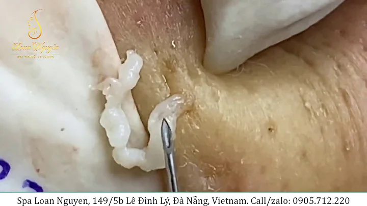 Removing large cysts for boys and whiteheads extraction (233) | Loan Nguyen