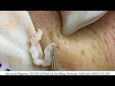 Removing large cysts for boys and whiteheads extraction (233) | Loan Nguyen