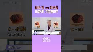 점일까? 암일까? ABCDE 룰로 확인💡