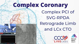 Complex PCI of SVG-RPDA Retrograde Limb and LCx CTO
