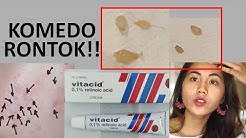 KRIM AMPUH ATASI KOMEDO, JERAWAT, BRUNTUSAN, BEKAS JERAWAT - Durasi: 18.58. 