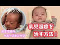 赤ちゃんのスキンケア 〜乳児湿疹を治した方法〜【育児Vlog】