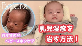 乳児湿疹 Youtube