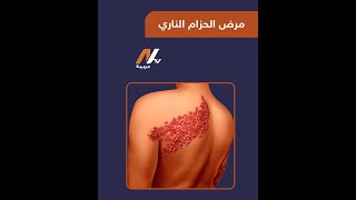 مرض الحزام الناري