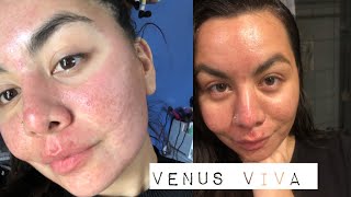 VENUS VIVA RESURFACING MICRONEEDLE TREATMENT screenshot 3