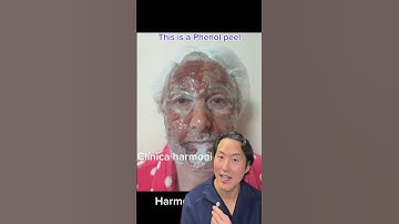Thumbnail of INCREDIBLE Chemical Peel Transformation! #shorts #chemicalpeel