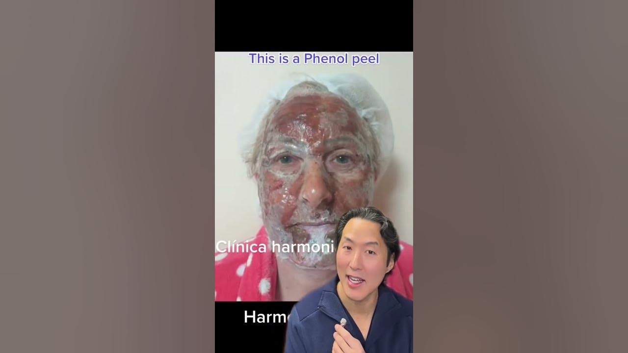 INCREDIBLE Chemical Peel Transformation! #shorts #chemicalpeel