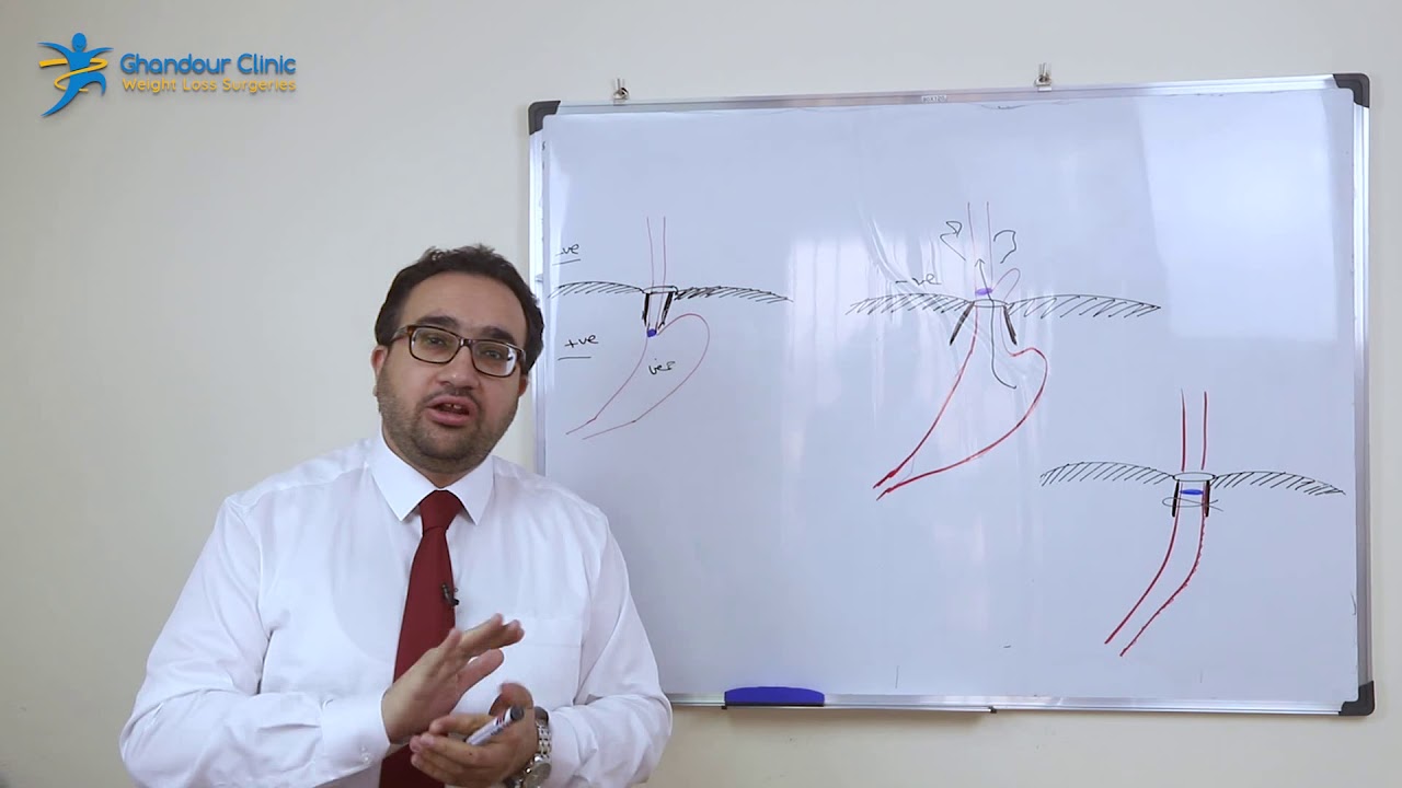 تأثير مشكلة فتق الحجاب الحاجز على عملية تكميم المعدة/الدكتور عبدالرحمن الغندور