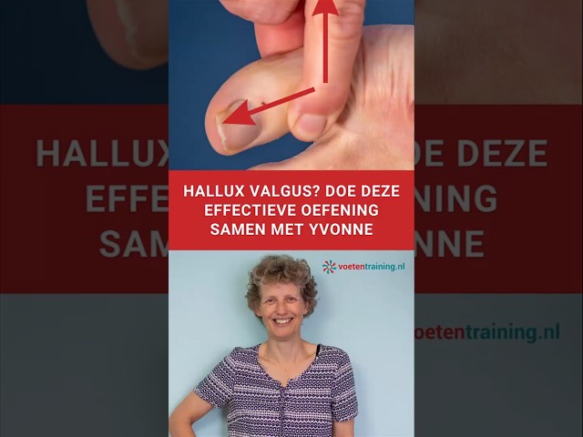 Doe mee met deze effectieve oefening voor de hallux valgus