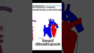 Reversed differential cyanosis-coarctation with TGA #nicu
