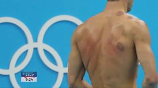 The Science Behind Cupping  The Trend In Rio