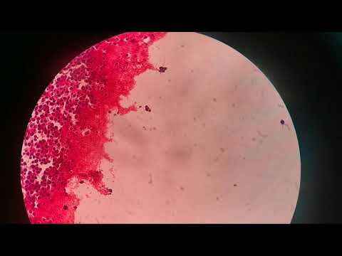 A closer look of Candida albicans gram stain|MEDICAL LABORATORY SCIENCE