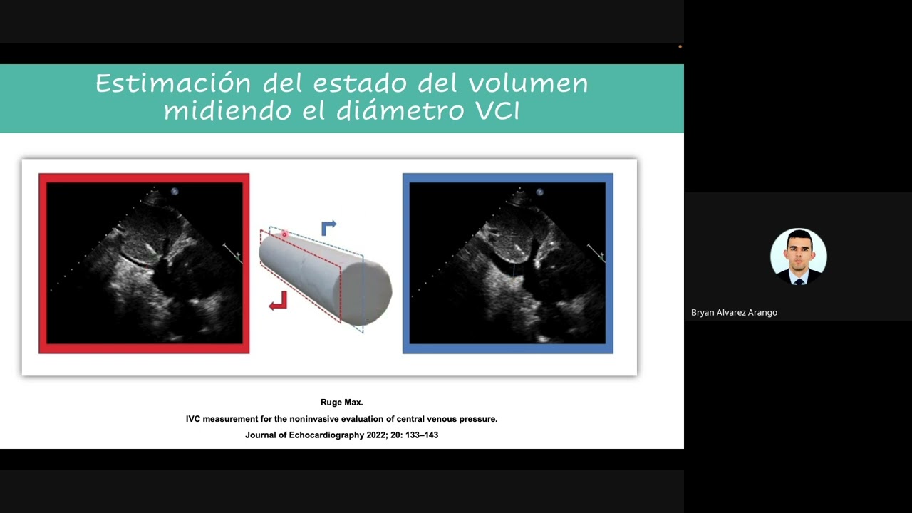 VCI (vena cava inferior): ¿ Al fin sirve para predicción de PVC, respuesta a volumen o ambos ?