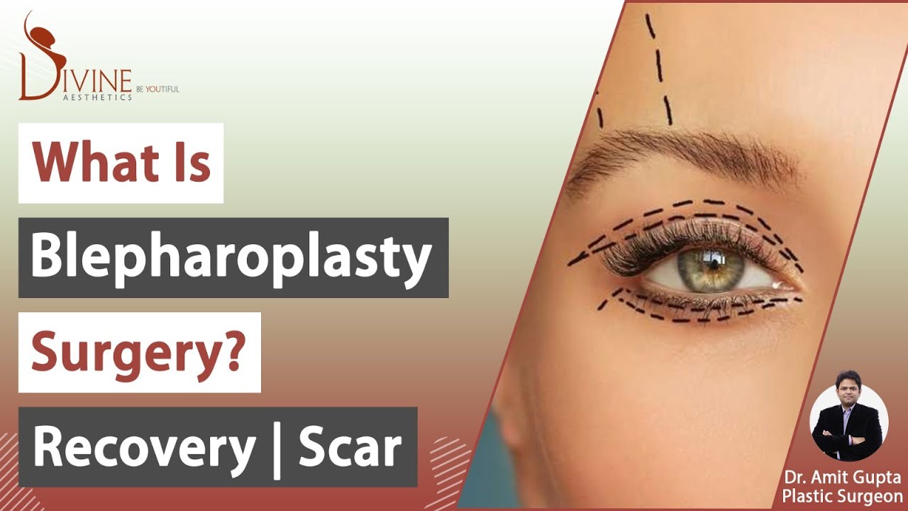 What is Blepharoplasty Surgery? Right Candidate Recovery Scar