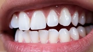 3 простых способа быстро отбелить зубы в домашних условиях