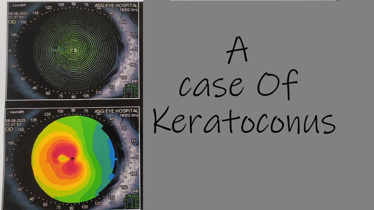 Keratoconus | Case | Keratometry | Pachymetry | Corneal steeping | Corneal mires