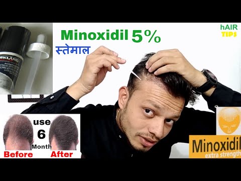 apply Minoxidil properly to best result- hair tips