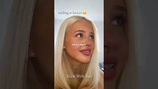 Best Braces Colors For Whiter Teeth Orthodontist Trick