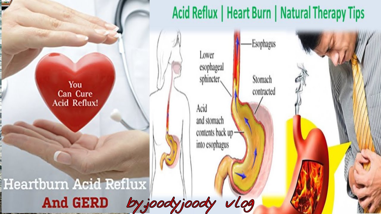 Heartburn and acid reflux (acid reflux )The natural Remedy YouTube