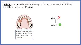 Kennedy's Classification & Applegate's rules - made simple!