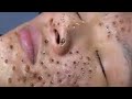 Loan nguyen acne treatment 14199