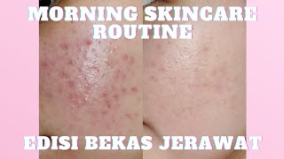 MORNING SKINCARE UNTUK BEKAS JERAWAT / OILY & ACNE PRONE SKIN / AIRIN BEAUTY CARE