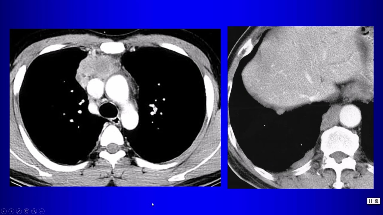 20a Anterior Mediastinum