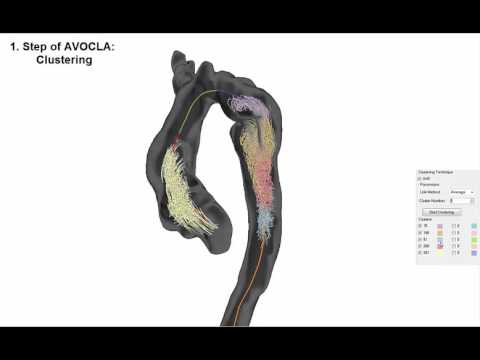 M. Meuschke: Semi-automatic Vortex Flow Classification in 4D PC-MRI Data of the Aorta