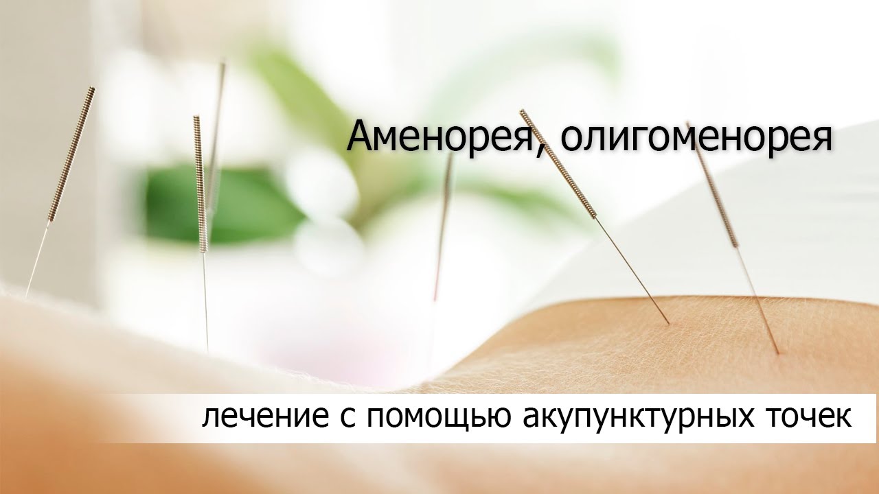 Аменорея, олигоменорея, Amenorrhea, oligomenorrhea - YouTube