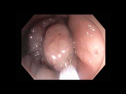 Video: Polipektomi: Prosedur Pembedahan Dan Pemulihan