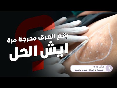 علاج فرط التعرق تحت الإبط بالبوتكس