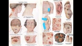 Mandatory Reporting of STIs Sexually Transmitted Infections; track disease trends, prevent outbreaks
