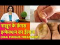 नाखून की फ़ंगस इन्फेक्शन का ईलाज || Treating Fungal Infection In Nails