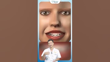 Niềng Răng Khớp Cắn Sâu | Bác Sĩ Yên