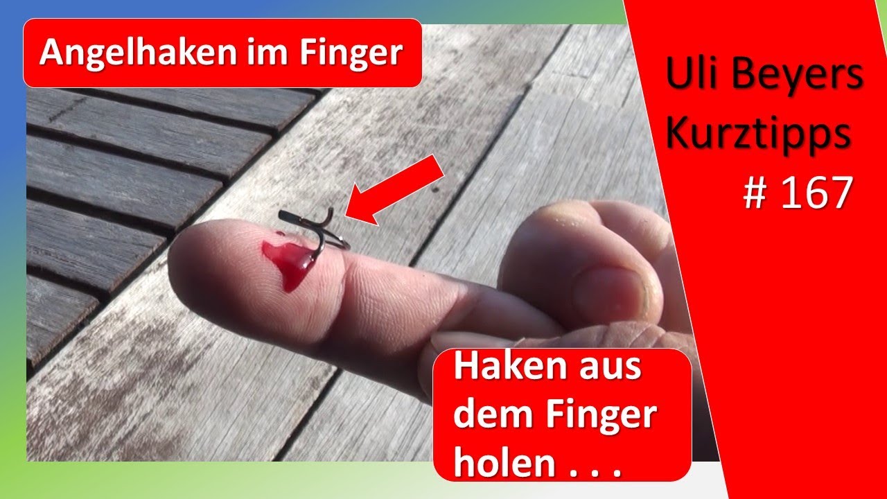 Angelhaken im Finger entfernen
