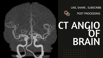 CT Angiography Brain Post Process of Filming.