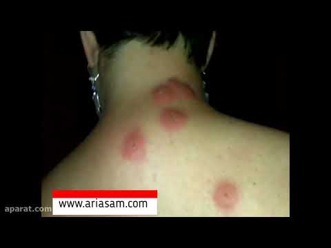 نشانه های گزش ساس و شناسایی آن