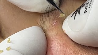 Relaxing Acne Cleansing with LinhMyDang P3 #589