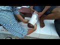 Pengukuran Kaki Palsu Kerjasama BFLF dan Yayasan Metro Group Pengukuran Kaki Palsu Kerjasama BFLF dan Yayasan Metro Group