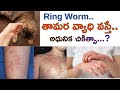 తామర వ్యాధికి అధునిక చికిత్స/RING WORM LATEST TREATMENT@DOCTORSADVICETELUGU  #skin #ringworm