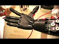 3d printed prosthetic arm