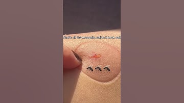 The ultimate solution for mosquito bites #shorts