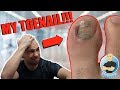Is the Toe Bro a Wimp? FOOT SPECIALIST CUTTING OWN DAMAGED TOENAIL!!! FOOT HEALTH MONTH 2018 #1