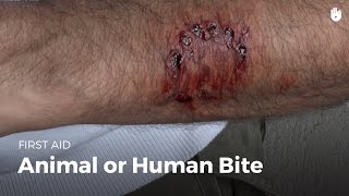 First aid: animal or human bite | First Aid
