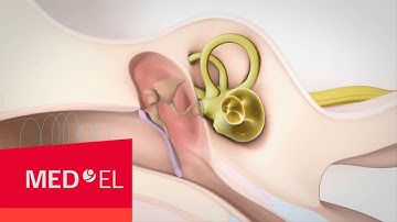 Mixed Hearing Loss  Sensorineural and Conductive Hearing Loss | MED-EL