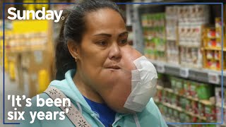 Tongan mum gets life-saving facial tumour surgery in New Zealand | Sunday