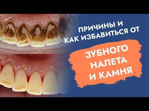 Камни на зубах. Налет на зубах. Причины. Как избавиться?