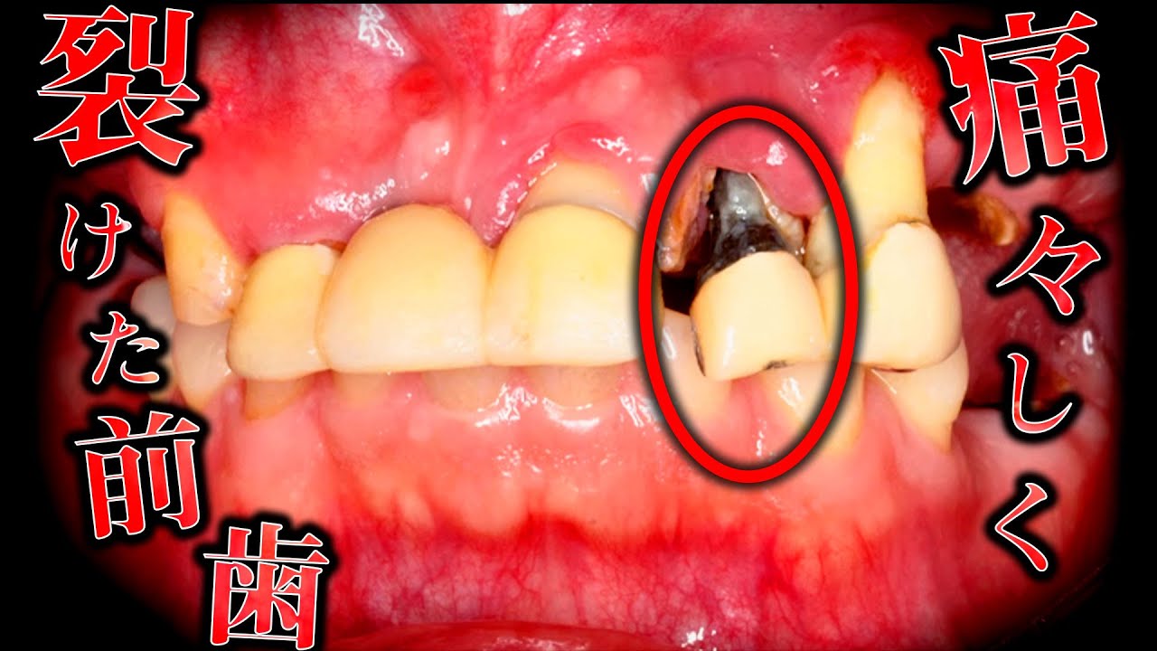 人口芝で何回かした使っていなかったので歯はほとんど削れていません。 40s] Encountering a mouth with an overwhelming number of problems