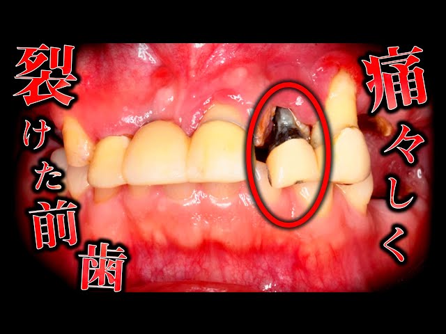 人口芝で何回かした使っていなかったので歯はほとんど削れていません。 40s] Encountering a mouth with an overwhelming number of problems